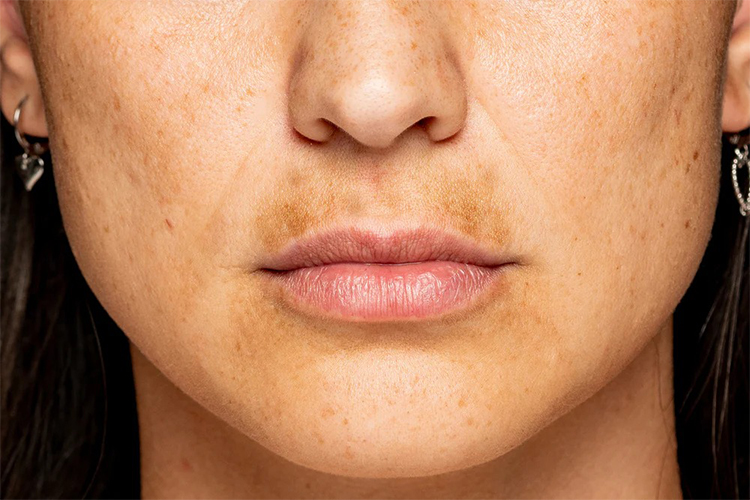 Uneven Skin Tone: Treatments, Home Remedies and Treatment Tips