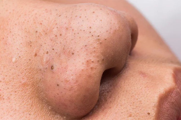 4 ways to get rid of blackheads in your ears and tips for prevention