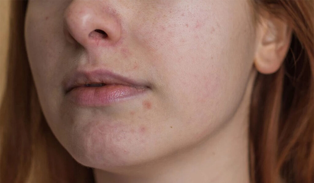 Can Mederma be used to treat acne scars?