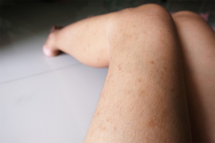 Dark spots on legs: causes, home remedies and treatment