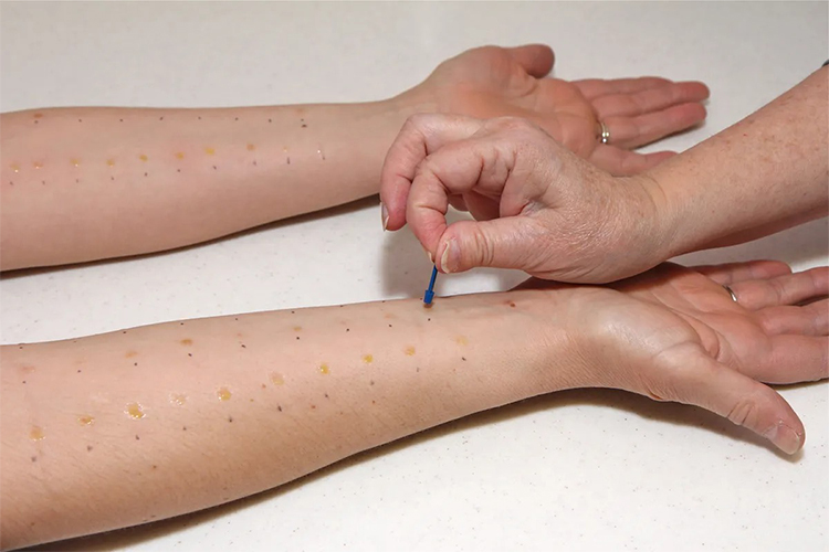 Skin prick test
